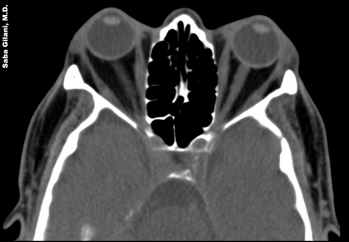 Roentgen Ray Reader Graves Ophthalmopathy