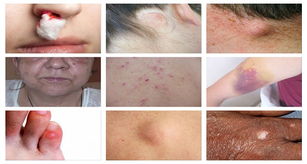 cancer facial simptome