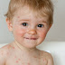 Cacar Air (Varicella) – Penyebab, Gejala, dan Pengobatan Cacar Air (Varicella) – Penyebab, Gejala, dan Pengobatan