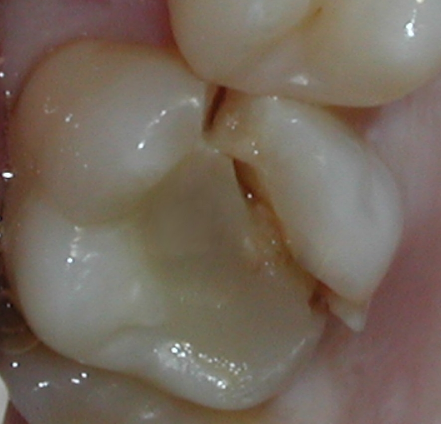 Root fracture Dental Trauma Guide