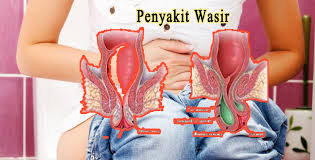 Foto Obat Herbal Benjolan Daging Keluar Dari Dubur Bol Saat Bab Terbaik