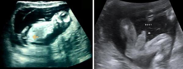 13 Haftalık Erkek Bebek Ultrason Görüntüsü 13 Haftalık Erkek Bebek Ultrason Görüntüsü