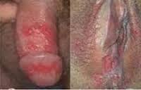 lecet disekitar vagina lecet disekitar vagina