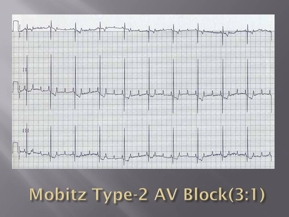 Av block remover сайт. Mobitz Type 1. Mobitz Type 2. High Grade при АВ блок. Complete Heart Block Dogs.