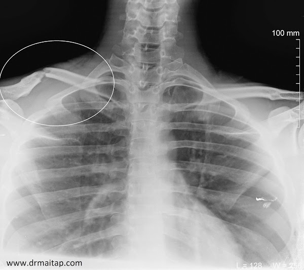 Amnesia anterograda posterior a trauma craneoencefalico (enfermedad de Dory) Amnesia anterograda posterior a trauma craneoencefalico (enfermedad de Dory)