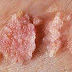 Obat Kutil Kelamin / Benjolan / daging tumbuh Paling Ampuh Di Apotik thumbnail
