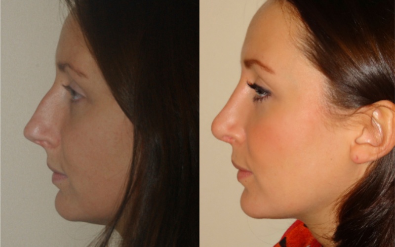 RESHAPING, REDEFINING, RESIZING NOSE WITH NOSE SURGERY(RHINOPLASTY/NOSE