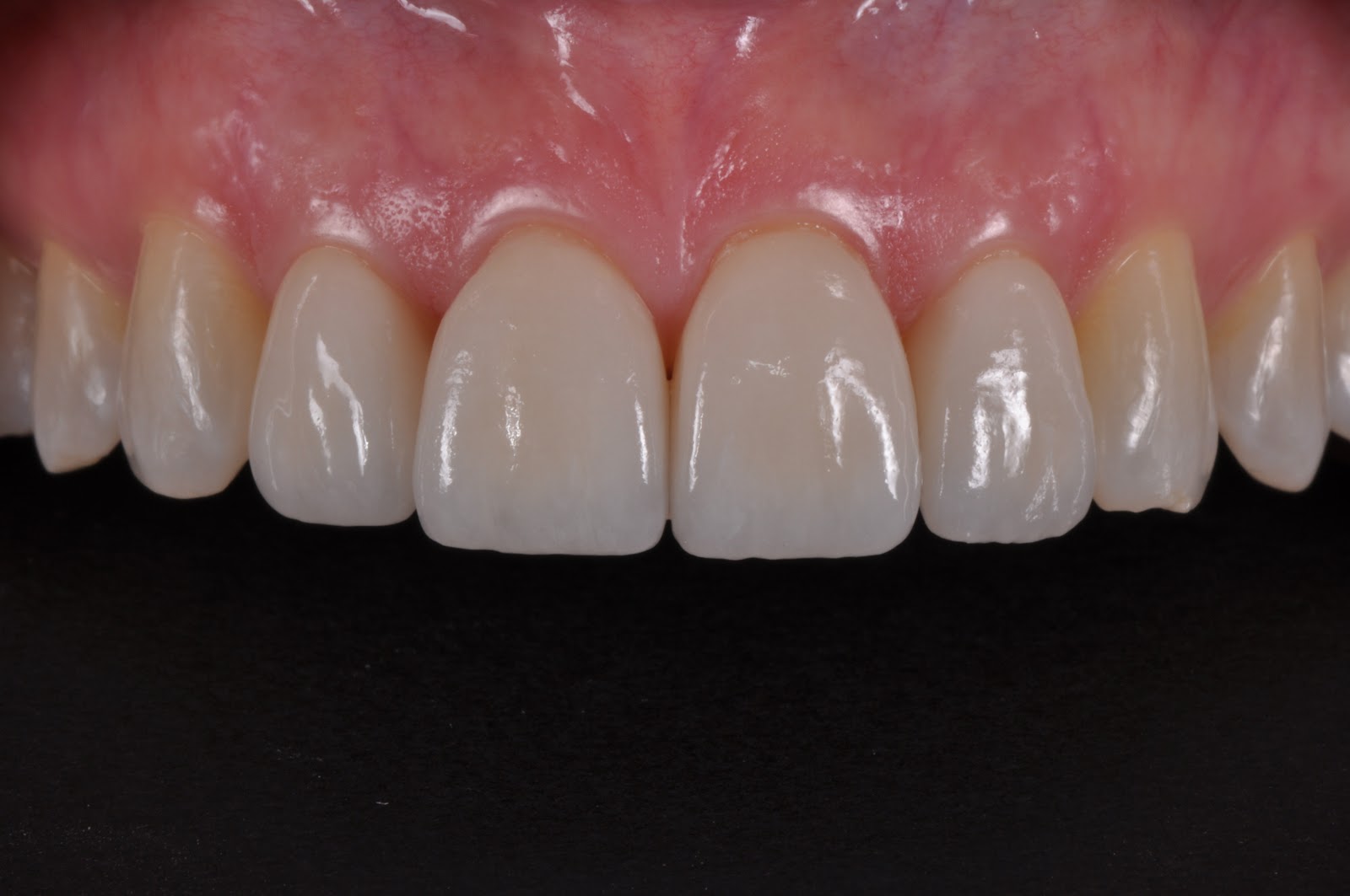 Dental Photography Pearls For Better Images Instantly: An easy (and  inexpensive) way to get black backgrounds for esthetic dental images
