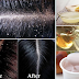 6 Simple Home Remedies to Remove Dandruff Naturally and Quickly!