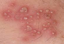 https://4.bp.blogspot.com/-njjRbzL1qzE/WQGw8TOf0OI/AAAAAAAAAdM/vTS2jBKkYlQJeuCgnRnVn8_godVBy6UiwCLcB/s1600/bintik%2Bherpes.jpg
