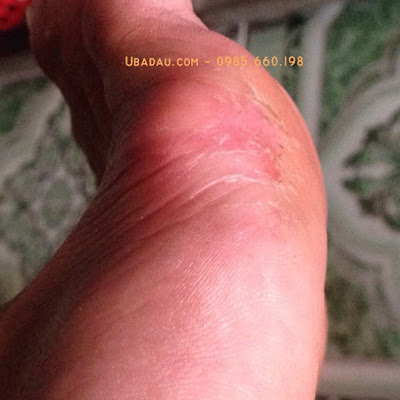 Mổ mắt cá chân bao lâu thì khỏi? Mổ mắt cá chân bao lâu thì khỏi?