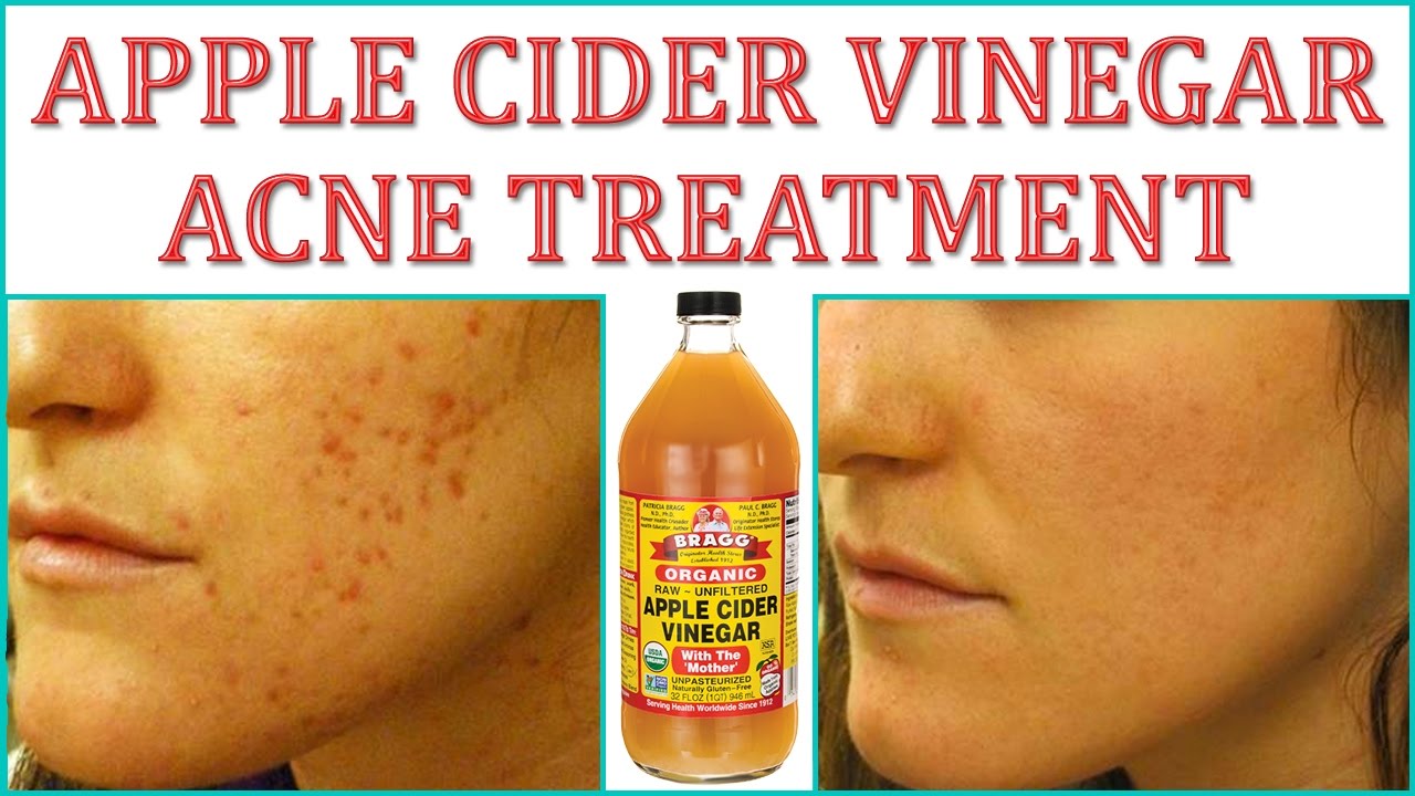 HOW TO GET RID OF PIMPLES ( ACNE ) OVERNIGHT FAST HOME REMEDIES HOW