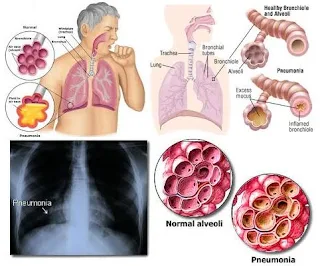 mengetahui penularan pneumonia