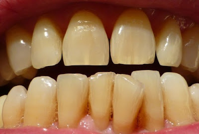 Nguyên nhân gây vàng răng là gì?