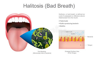 halitosis-www.healthnote25.com