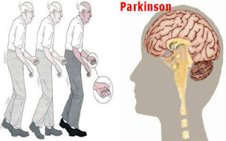 Bahaya Penyakit Parkinson dan Cara Mencegahnya Bahaya Penyakit Parkinson dan Cara Mencegahnya