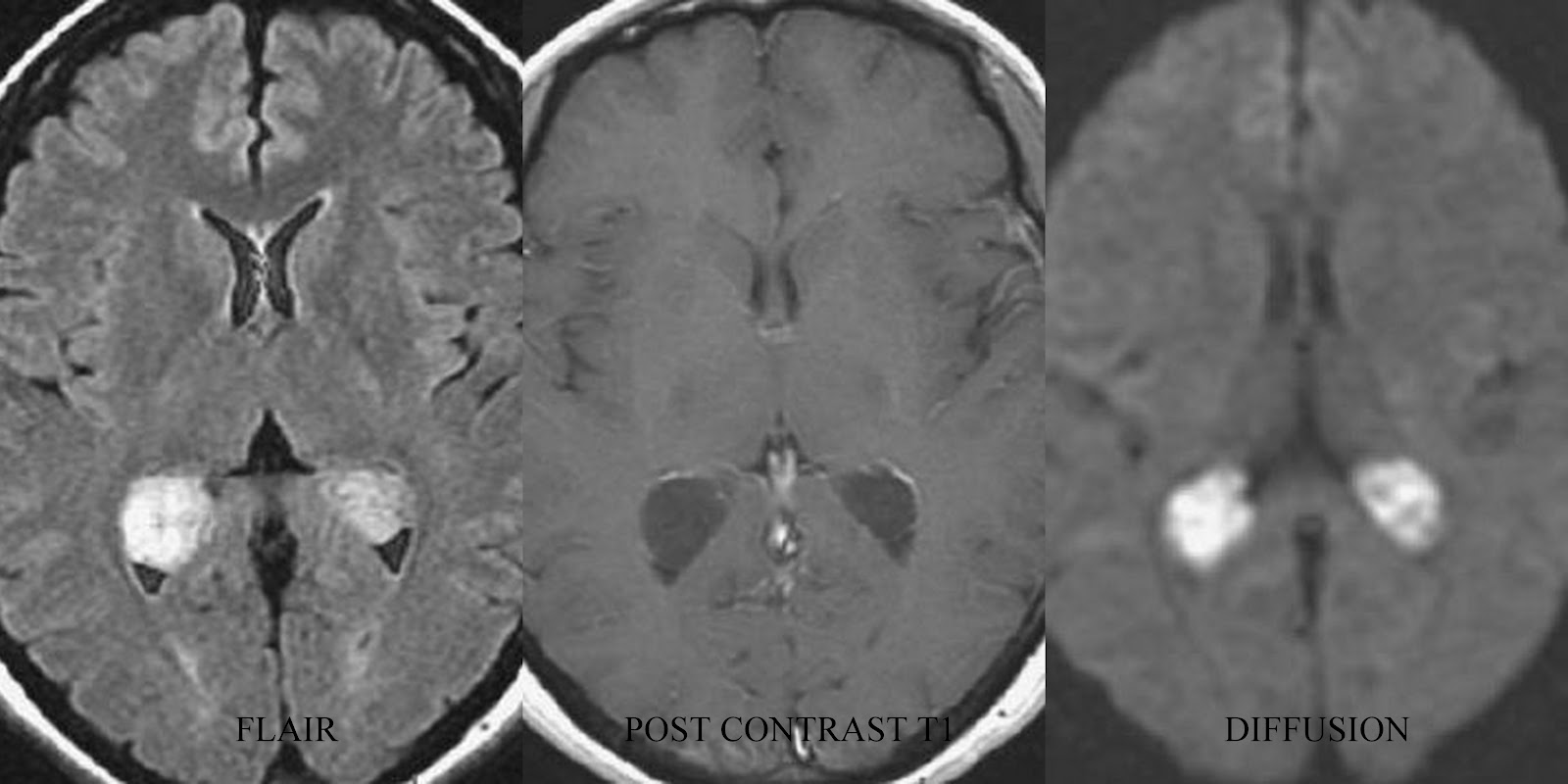 xanthogranuloma #10