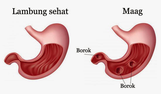 Sakit maag yang akut dapat mengakibatkan penyakit lain yaitu