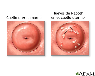 cuello uterino inflamado y rojo cuello uterino inflamado y rojo