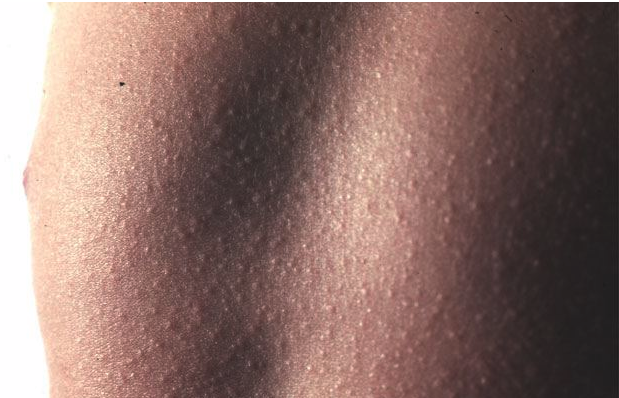 Can adults get scarlet fever picture