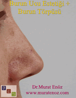 nose tip surgery, nose operation, nose tip reshaping, tip rhinoplasty, tip plasty, nose tip reduction, nose, tip refinement, tip rhinoplasty cost, nasal tip surgery, nasal tip refinement, nose tip surgery before and after, lift nose tip naturally, nose tip lift, nose tip reshaping cost, nose tip reshaping without surgery, bulbous, nose tip reshaping, nose tip reshaping before and after, reshaping nose tip, nasal tip reshaping, cost of nose tip reshaping, nose tip surgery, nasal tip surgery, nose tip surgery before and after, nose surgery, tip of the nose surgery, tip nose surgery, plastic surgery nose tip, bulbous nose tip surgery, nose, tip plastic surgery, nose surgery tip only, plastic surgery tip of nose, tip nose surgery before and after, tip surgery nose, nasal tip surgery before after, round nose tip surgery, surgery for bulbous nose tip, rhinoplasty tip surgery, bulbous tip surgery, nose surgery recovery tips, droopy nose tip surgery, nose tip surgery recovery, nose bridge reduction, nasal hump removal, nasal hump reduction, revision tip plasty