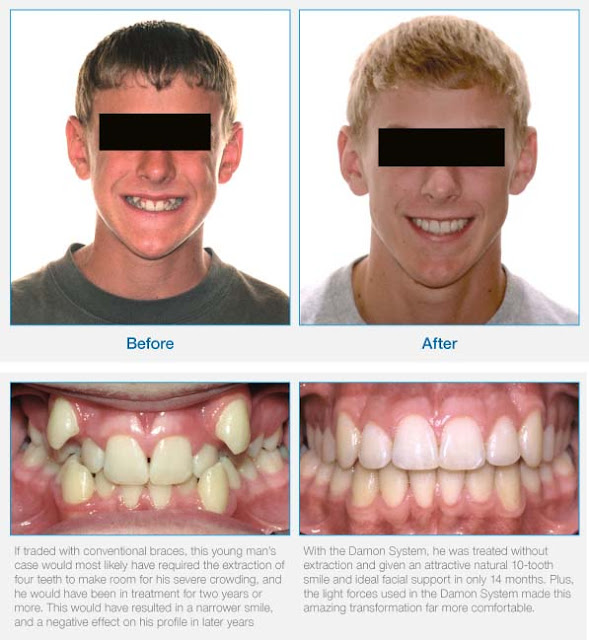 Quick, Accelerated Braces treatment with DAMON SYSTEM