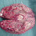 Penyakit Langka Dan Aneh Itu Bernama 'Naegleria Fowleri.'