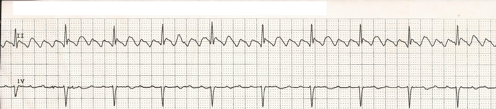 episodic atrial flutter icd 10 episodic atrial flutter icd 10