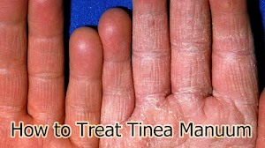 How to Treat Tinea Manuum How to Treat Tinea Manuum