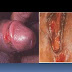 Obat sipilis di malaysia thumbnail