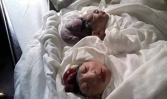 The birth of a strange twins baby in Sarishabari সরিষাবাড়ীতে অদ্ভুদ জমজ শিশু জন্ম
