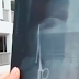 Médicos removem tesoura do abdômen do homem após 18 anos