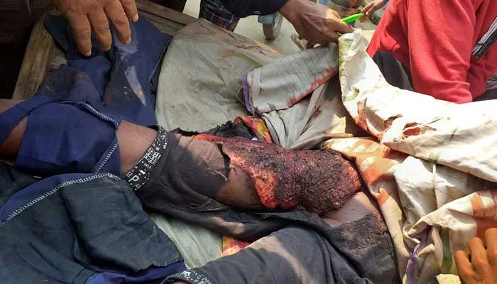 School student injured in Dewanganj crab press