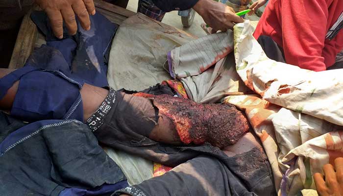 School student injured in Dewanganj crab press School student injured in Dewanganj crab press