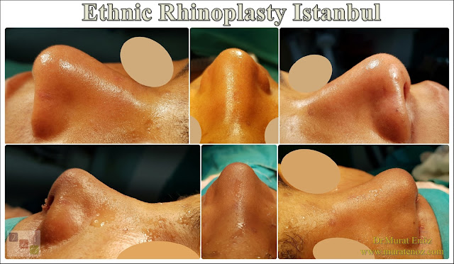 Ethnic Rhinoplasty Istanbul – Dr.Murat Enoz – Nose job in Istanbul – Nose surgery in Istanbul – Nose job in Turkey - Ethnic rhinoplasty Turkey - Ethnic rhinoplasty in Turkey - African American rhinoplasty - Ethnic expert nose job surgeon - Rhinoplasty surgeon in Istanbul - Black nose job - Rhinoplasty for ethnic nose - Rhinoplasty for African people - African American nose surgery – Rhinoplasty for African American Nose - Thick skin rhinoplasty - Rhinoplasty in istanbul Ethnic Rhinoplasty Istanbul – Dr.Murat Enoz – Nose job in Istanbul – Nose surgery in Istanbul – Nose job in Turkey - Ethnic rhinoplasty Turkey - Ethnic rhinoplasty in Turkey - African American rhinoplasty - Ethnic expert nose job surgeon - Rhinoplasty surgeon in Istanbul - Black nose job - Rhinoplasty for ethnic nose - Rhinoplasty for African people - African American nose surgery – Rhinoplasty for African American Nose - Thick skin rhinoplasty - Rhinoplasty in istanbul