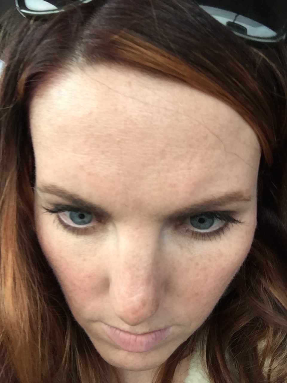 topical retinoid cream for freckles