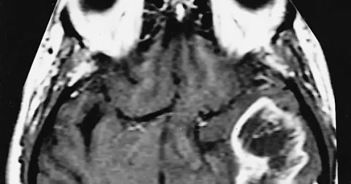 ring enhancing lesions usmle ring enhancing lesions usmle