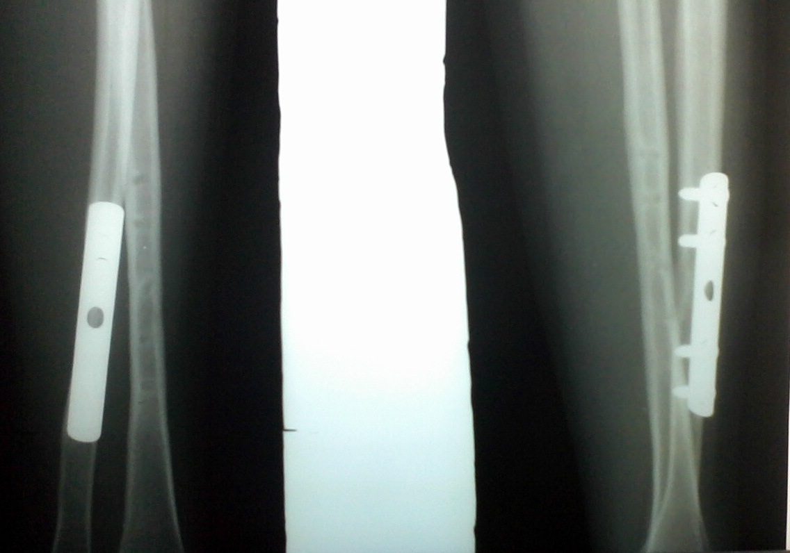 Fiksasi patah tulang lengan radius ulna - Medianers