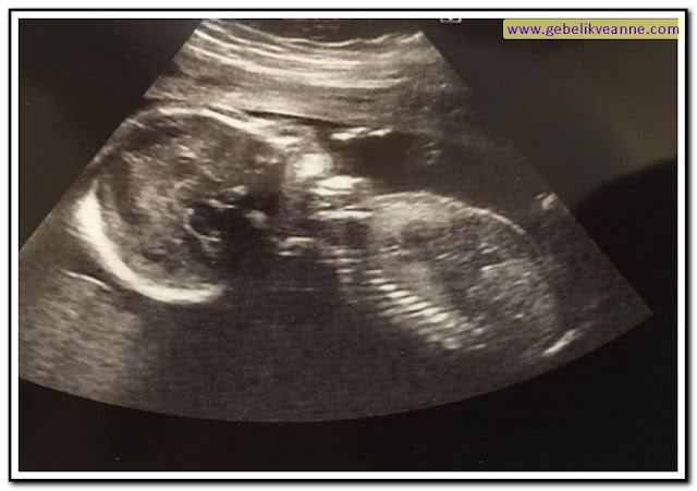 21 haftalık hamilelik (gebelik) ultrason görüntüsü