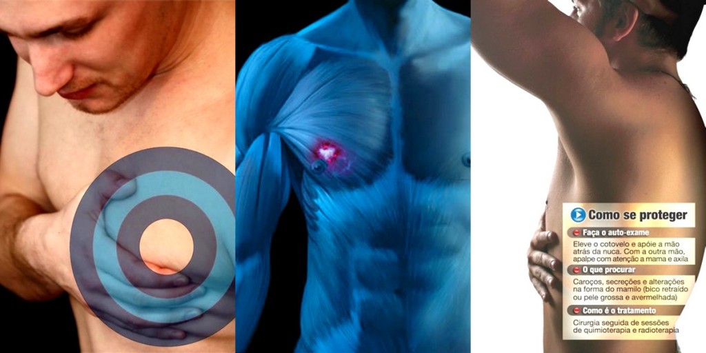 Resultado de imagem para CANCER DE MAMA HOMENS