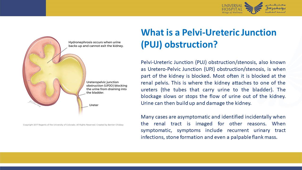 Successful A H Pyeloplasty For Puj Obstruction In A Duplex Kidney Dr