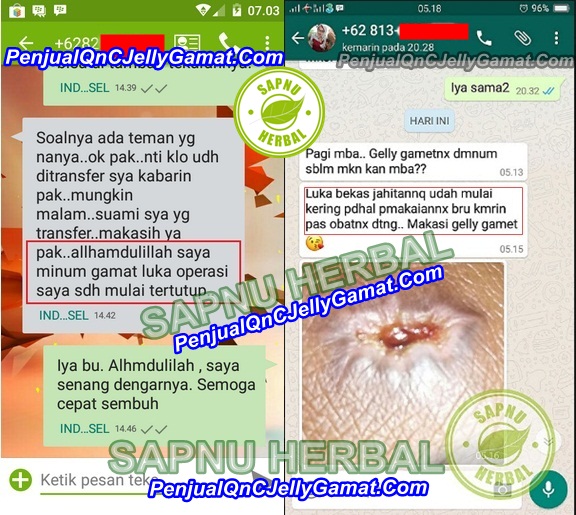 Cara Cepat Mengobati Luka Bakar Tanpa Membekas Cara Cepat Mengobati Luka Bakar Tanpa Membekas