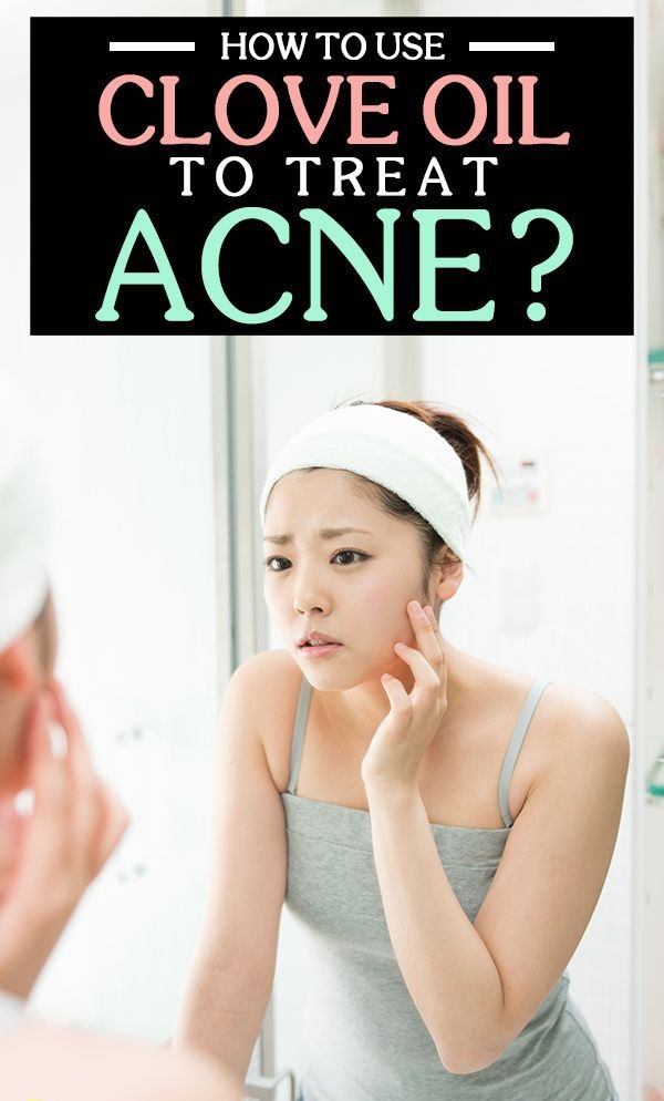 How to Use Clove Oil for Acne