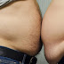 Cara Ampuh Mengatasi Obesitas Atau Kegemukan