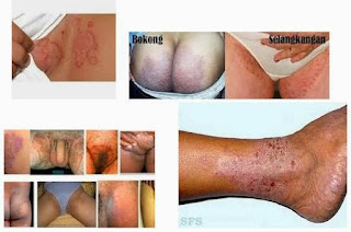 Pengobatan eksim basah dan eksim kering Pengobatan eksim basah dan eksim kering