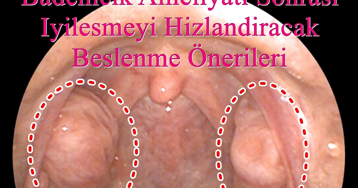 KBB Uzmanı Bakırköy Bademcik Ameliyati Sonrası İyilesmeyi