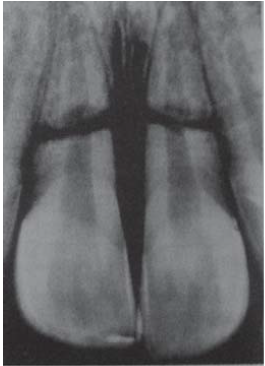 Ellis and Davey Classification - Endodontics and Oral ...