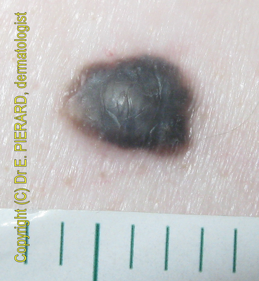 dermoscopy: April 2013