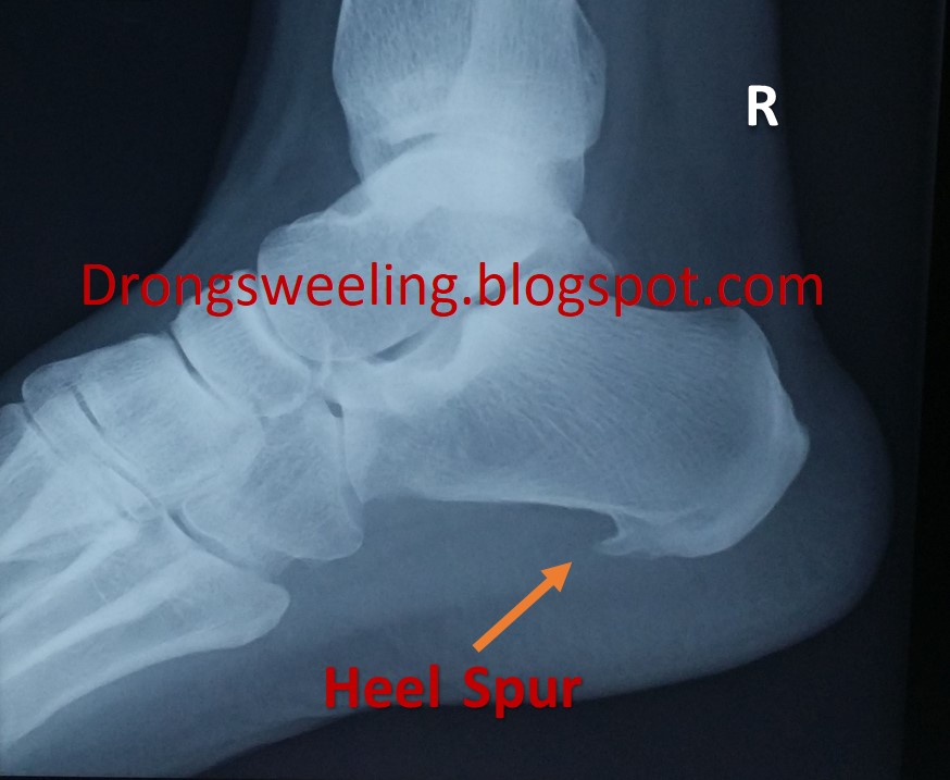 TCM News TCM Physician Treat Heel Spur Neck Pain with Acupuncture