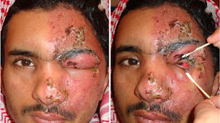 herpes pada mata herpes pada mata